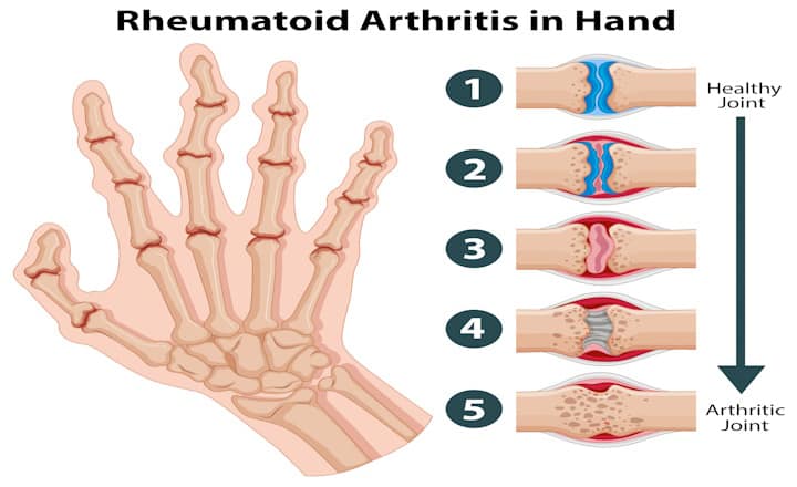 Rheumatoid Arthritis in Hand